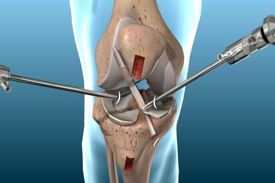 ACL Tear Surgery